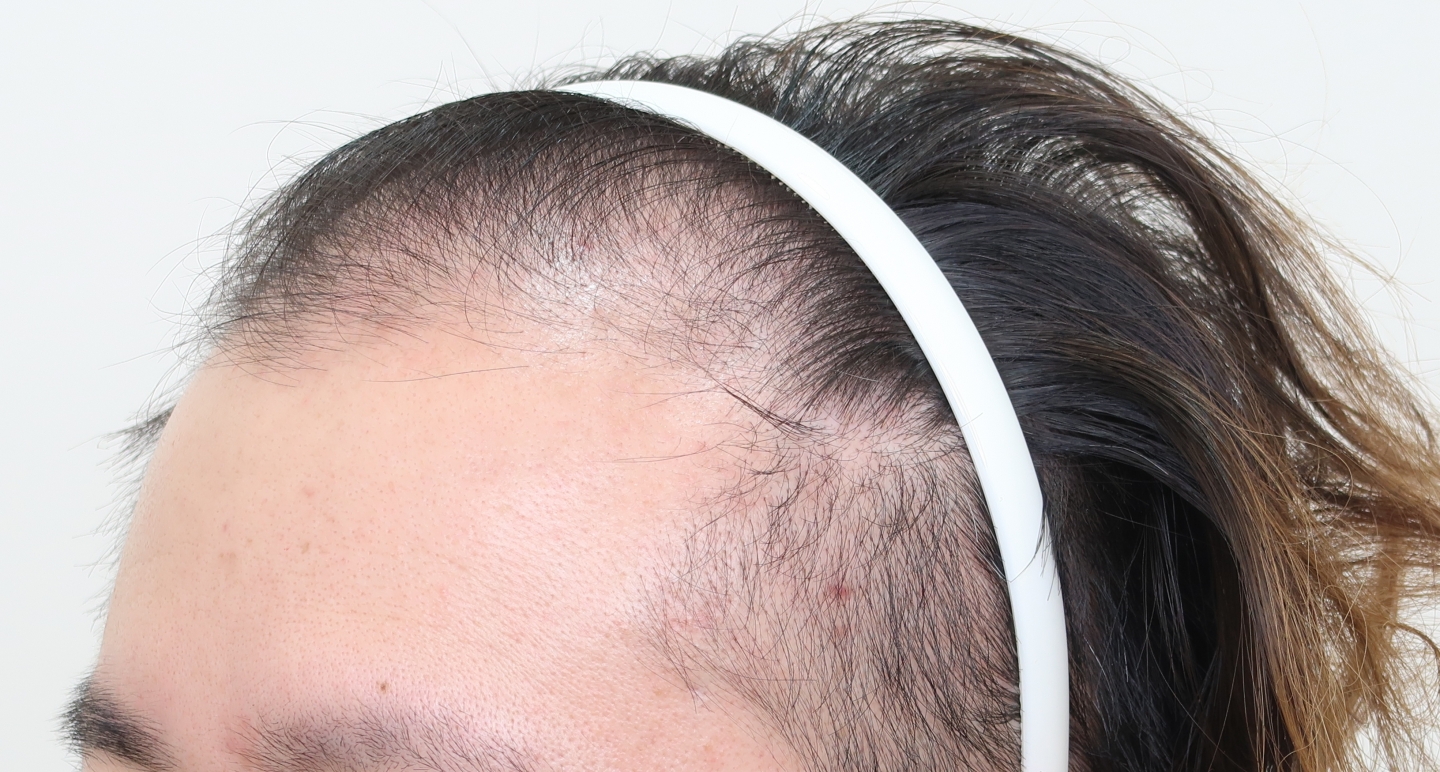 遺傳禿頭植髮心得：術前側面