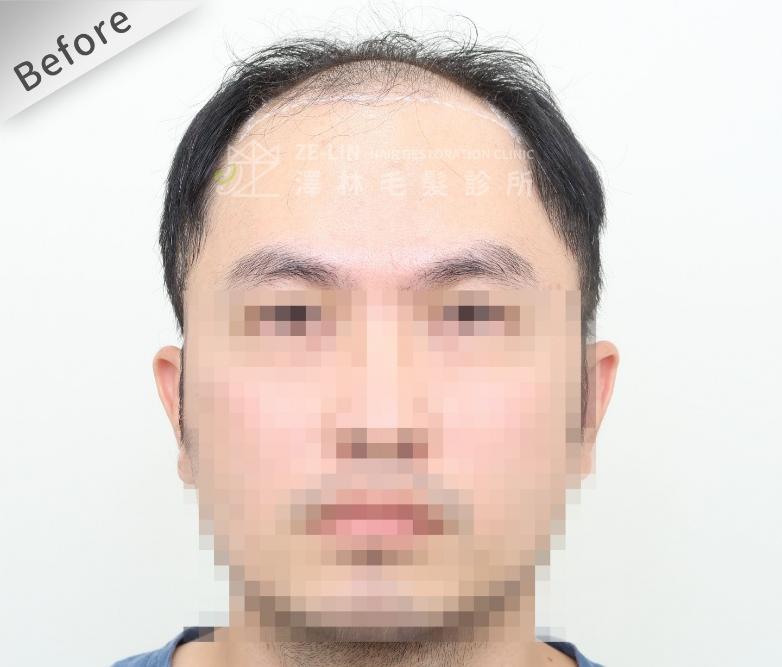 FUE植髮案例：術前正面