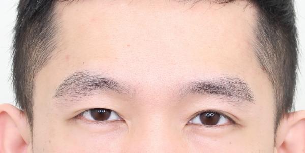 植眉推薦澤林毛髮診所謝宗廷醫師-眉頭稀疏斷眉紋眉繡眉飄眉-術後4-1