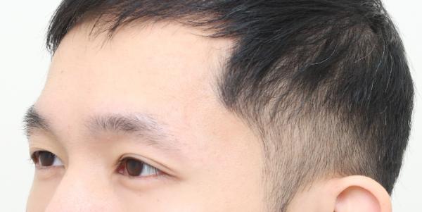 植眉推薦澤林毛髮診所謝宗廷醫師-眉頭稀疏斷眉紋眉繡眉飄眉-術前4-2