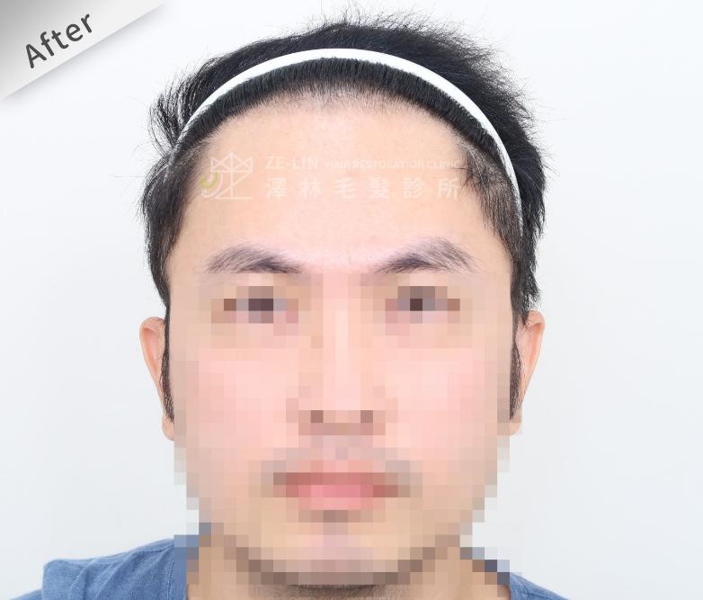 FUE植髮案例：術後正面
