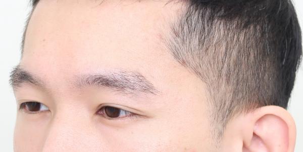 植眉推薦澤林毛髮診所謝宗廷醫師-眉頭稀疏斷眉紋眉繡眉飄眉-術後4-2