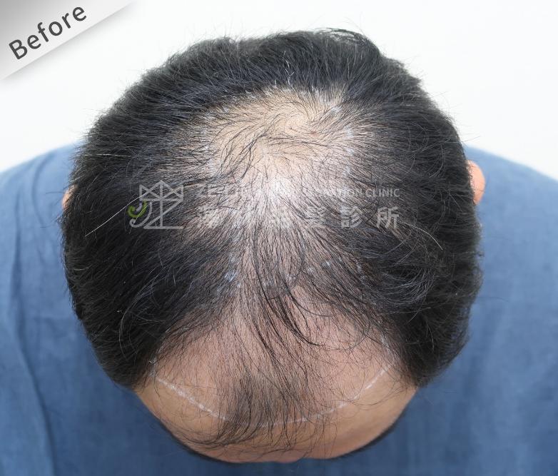 FUE植髮案例：術前頭頂
