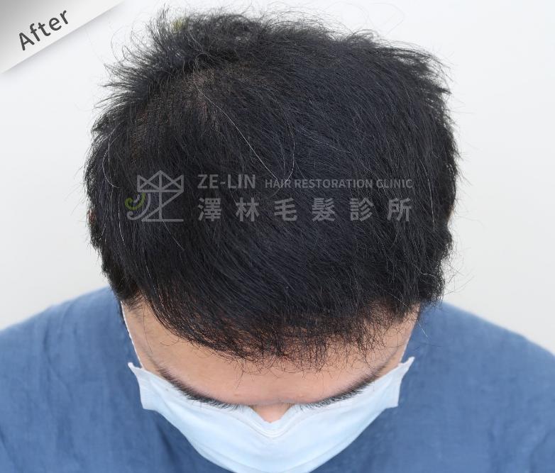 FUE植髮案例：術後頭頂