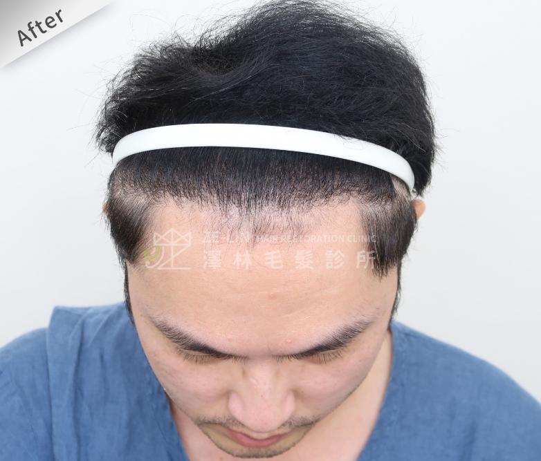 FUE植髮案例：術後髮際線
