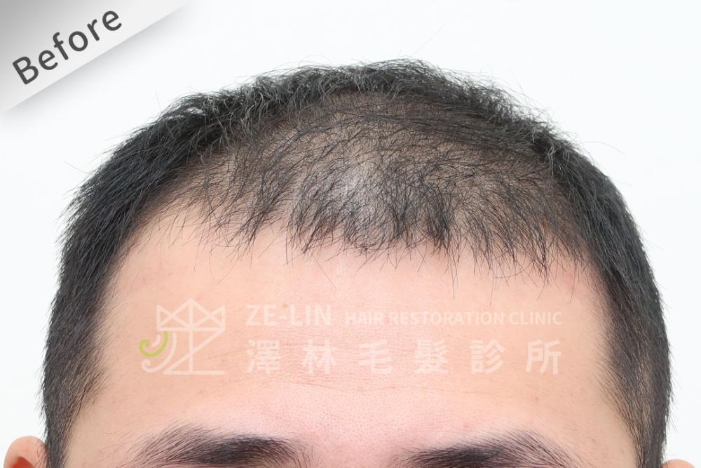 巨量植髮心得：術前前額