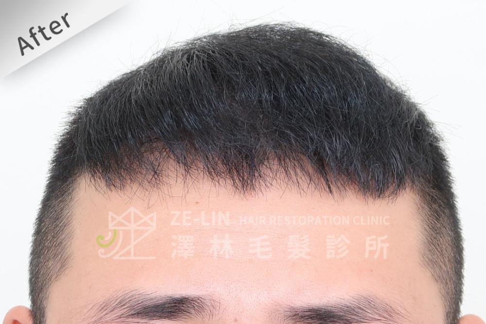 巨量植髮心得：術後前額