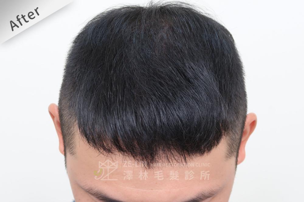 巨量植髮心得：術後頭頂
