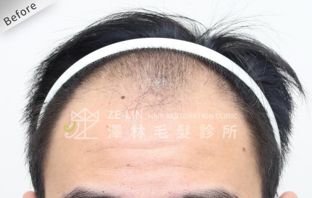 雄性禿植髮心得：術前前額