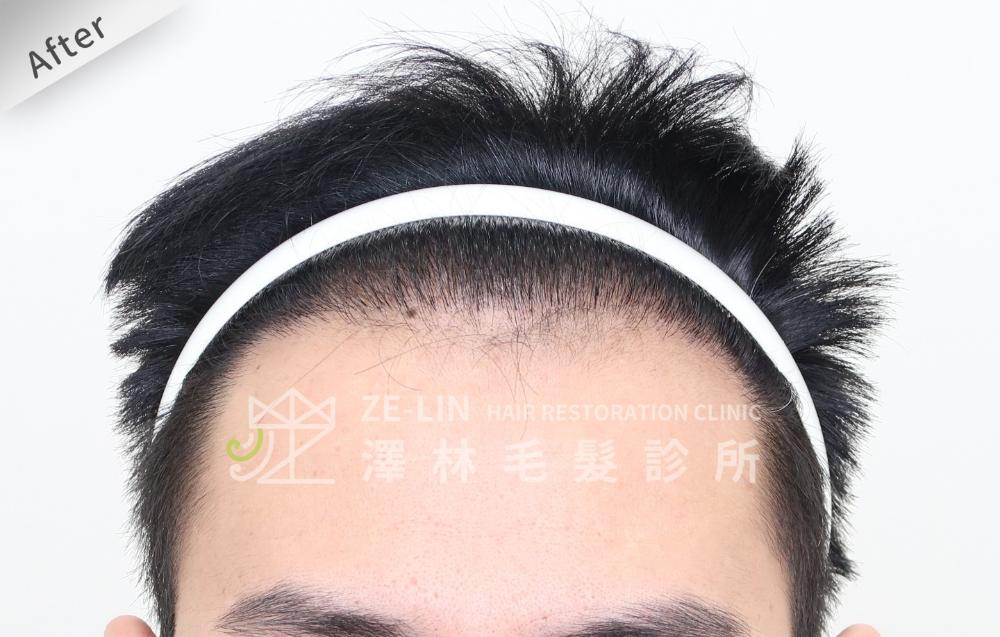 雄性禿植髮心得：術後前額