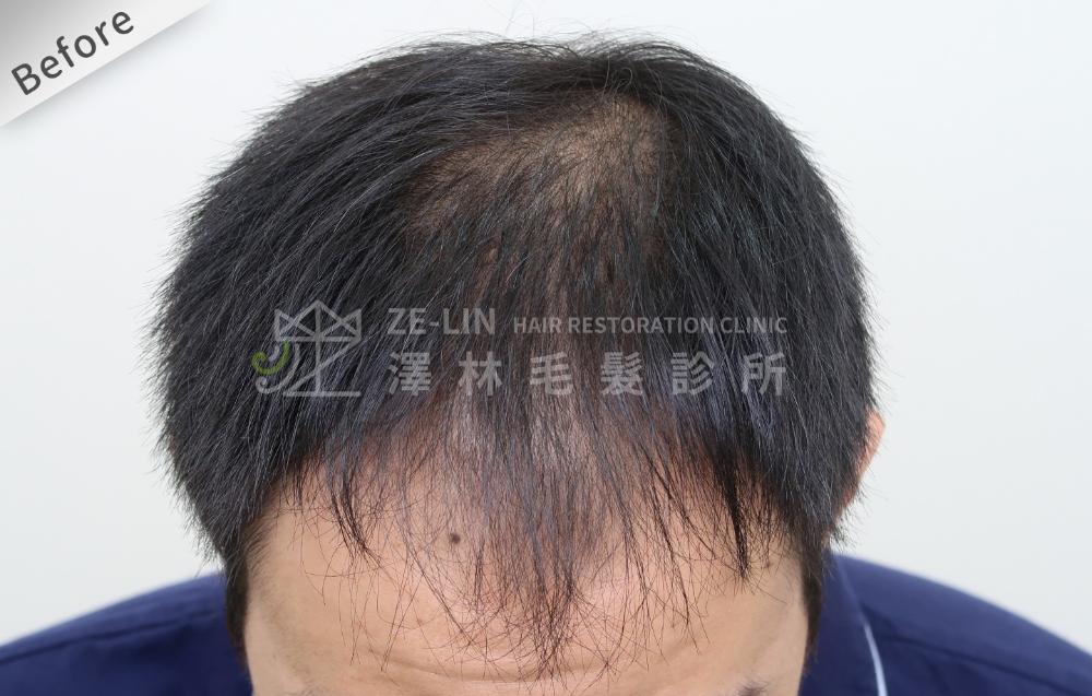 雄性禿植髮心得：術前頭頂
