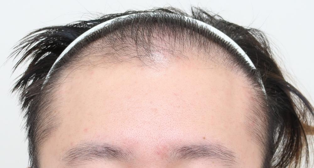 遺傳禿頭植髮心得：術前正面