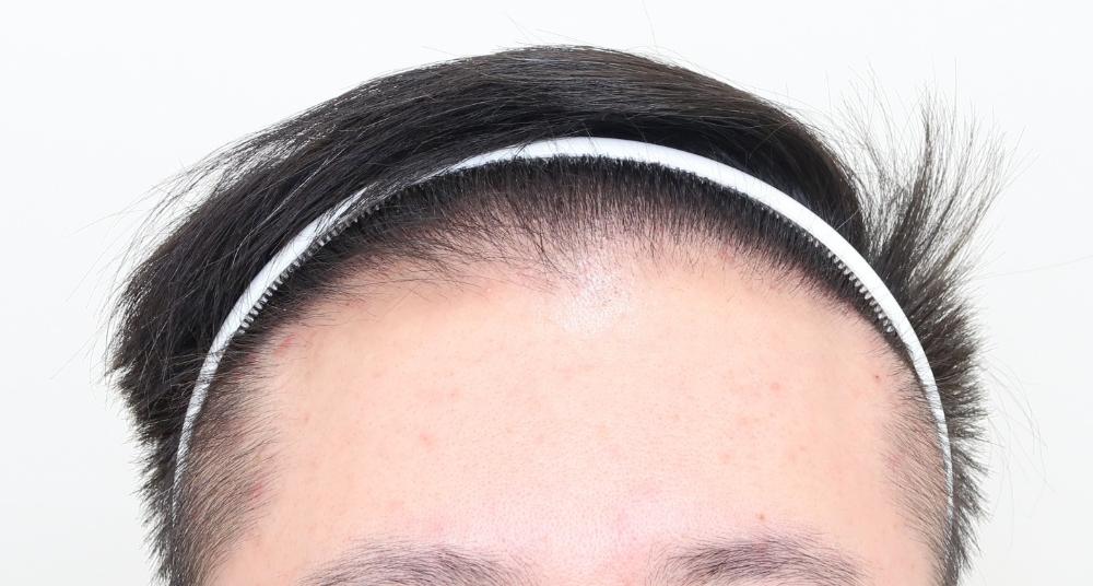 遺傳禿頭植髮心得：術後正面