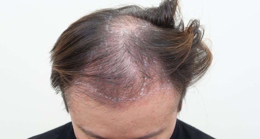 遺傳禿頭植髮心得：術前頭頂