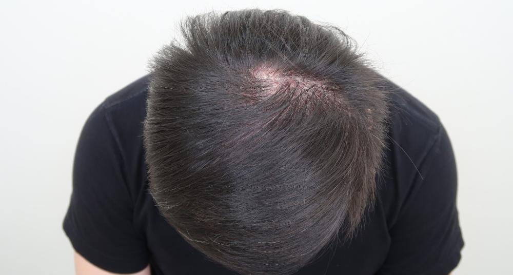 遺傳禿頭植髮心得：術後頭頂
