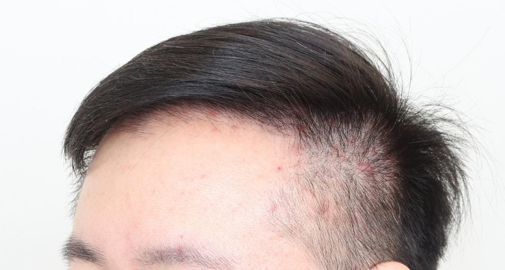 遺傳禿頭植髮心得：術後側面