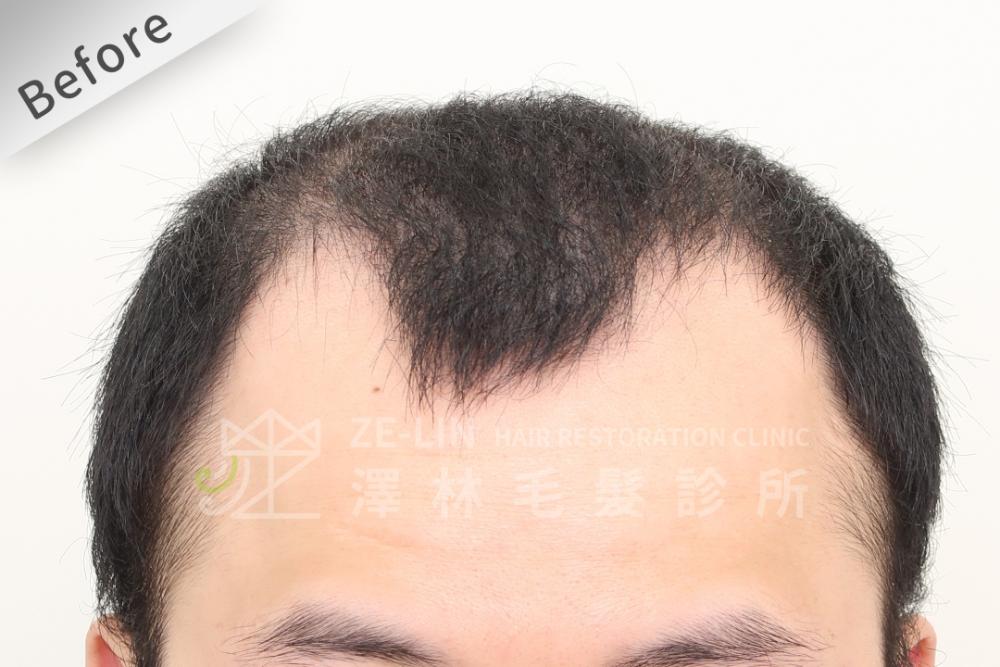 雄性禿植髮評價：術前正面