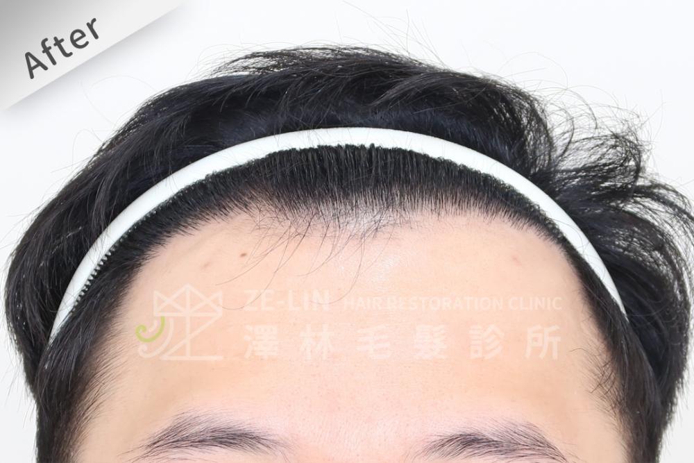 雄性禿植髮評價：術後正面