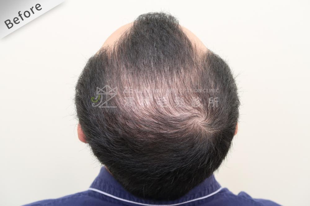 雄性禿植髮評價：術前頭頂