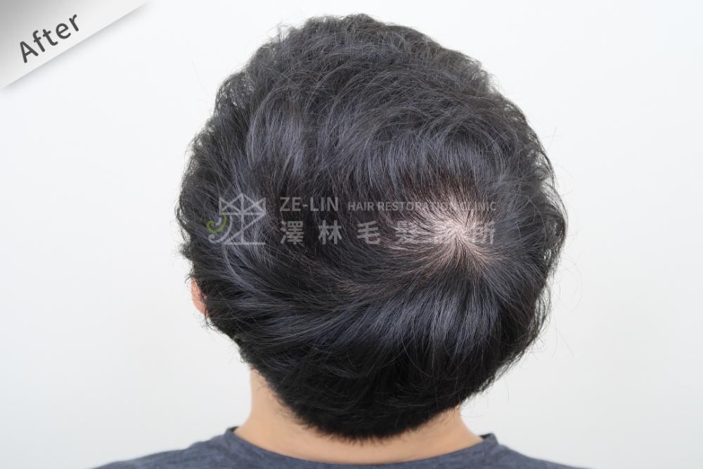 雄性禿植髮評價：術後頭頂