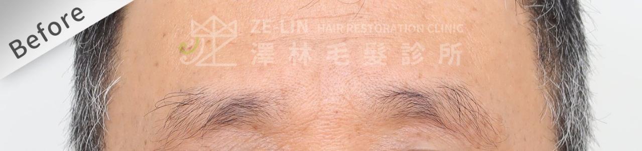 植眉推薦澤林毛髮診所謝宗廷醫師-缺眉斷眉紋眉繡眉飄眉-眉型調整-術前1-1