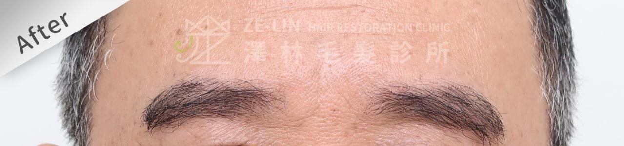 植眉推薦澤林毛髮診所謝宗廷醫師-缺眉斷眉紋眉繡眉飄眉-眉型調整-術後1-1