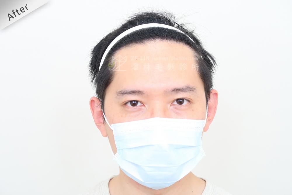 植髮心得：術後正面