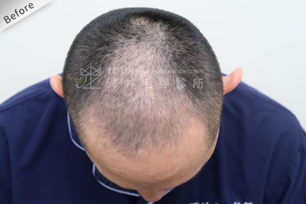 植髮心得：術前頭頂