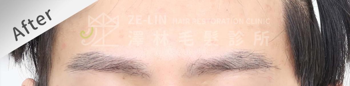 植眉推薦澤林毛髮診所謝宗廷醫師-缺眉斷眉紋眉繡眉飄眉-眉型調整-術後2-1