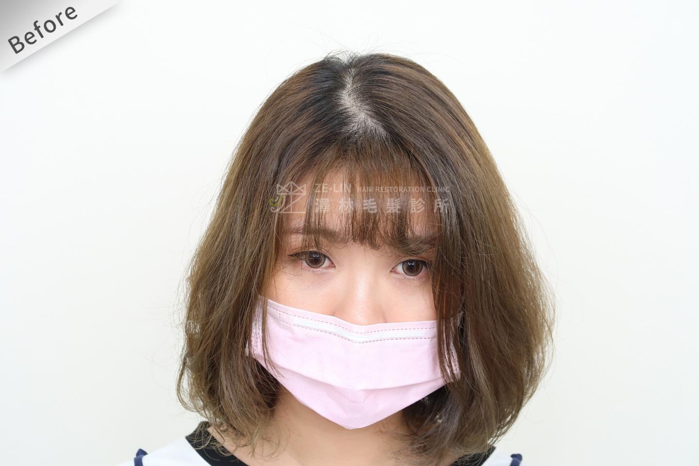 PRP自體生長因子育髮治療女生雄性禿改善頭頂看到頭皮術前（１）