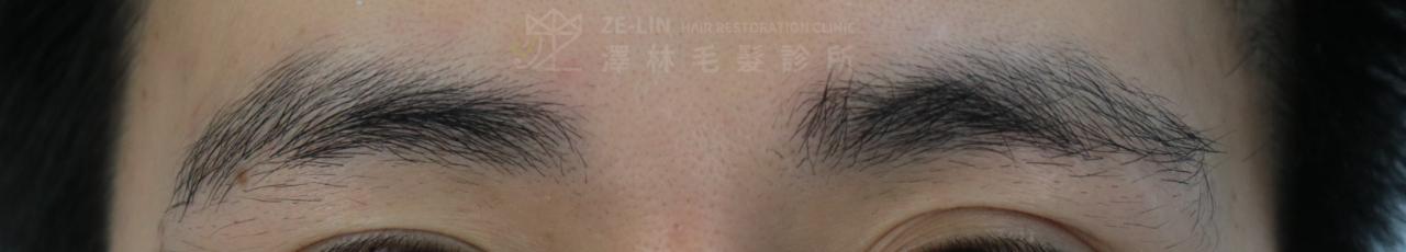 植眉推薦澤林毛髮診所謝宗廷醫師-缺眉斷眉紋眉繡眉飄眉-眉型調整-術前3-1