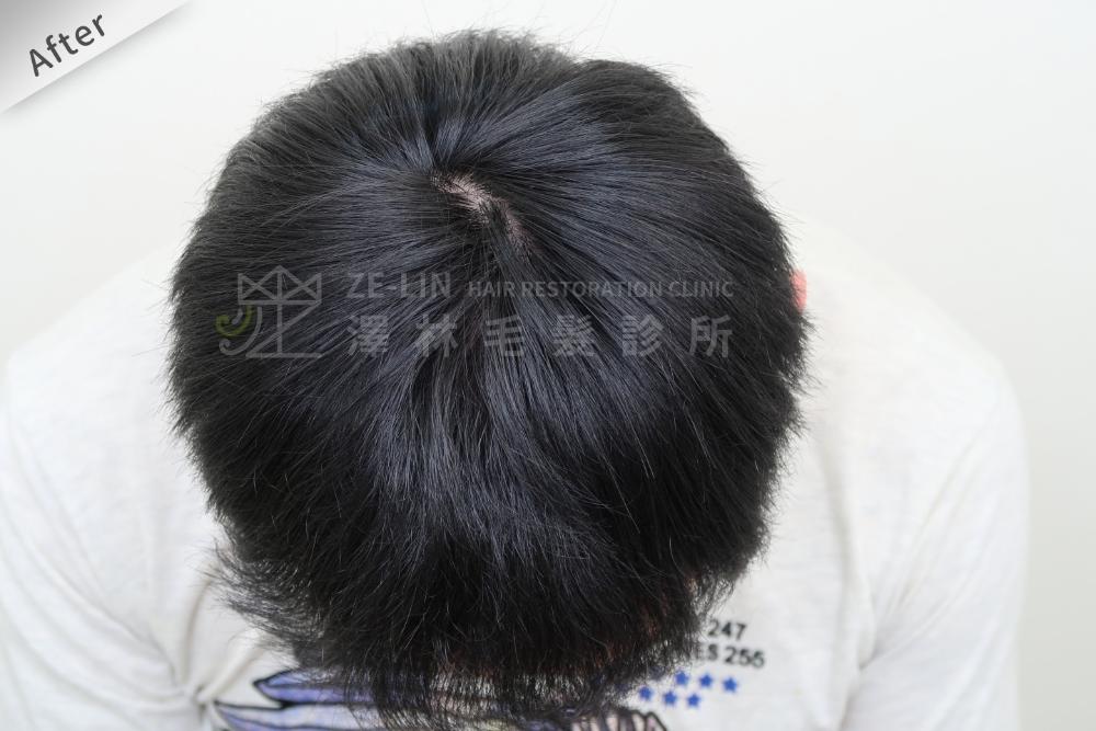 植髮心得：術後頭頂
