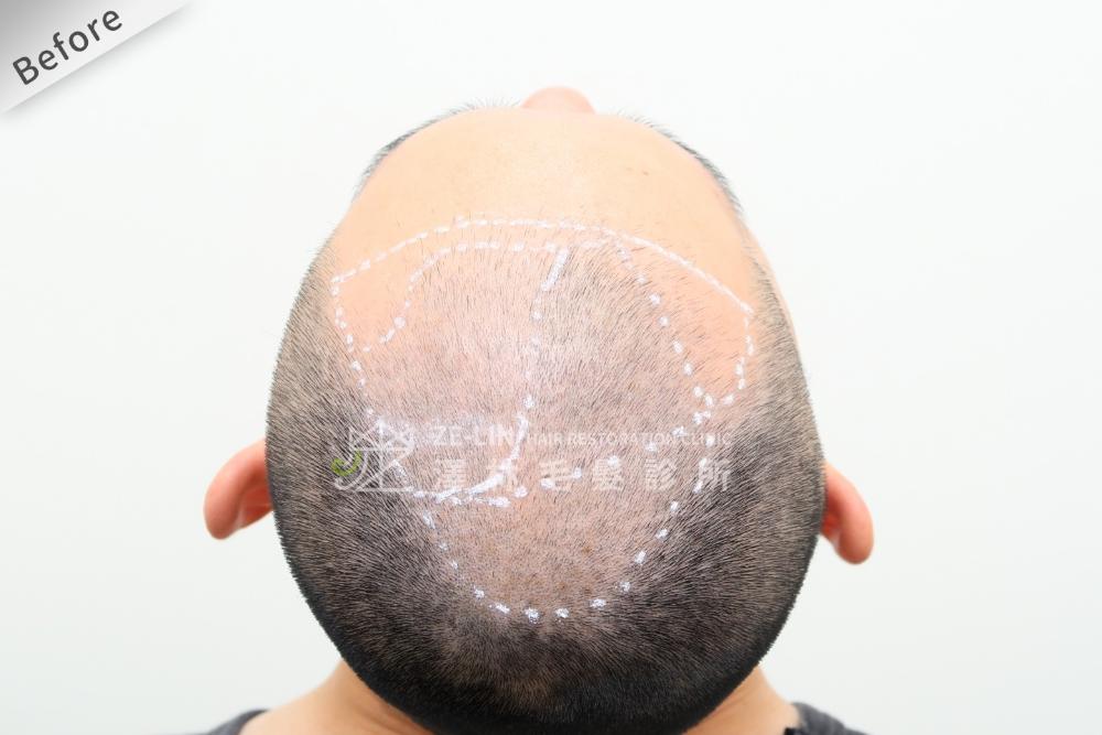 植髮評價：術前頭頂