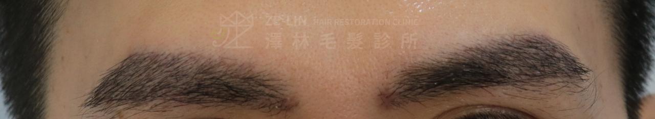 植眉推薦澤林毛髮診所謝宗廷醫師-缺眉斷眉紋眉繡眉飄眉-眉型調整-術前3-2