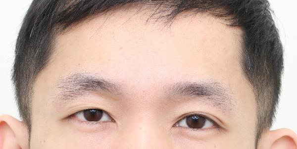 植眉推薦澤林毛髮診所謝宗廷醫師-眉頭稀疏斷眉紋眉繡眉飄眉-術前4-1