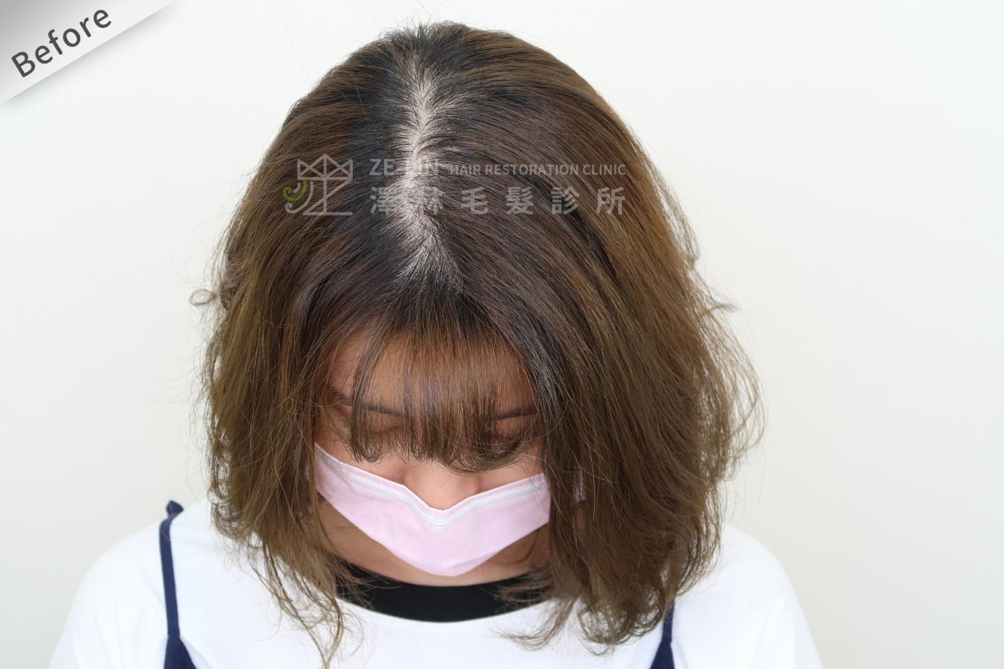 PRP自體生長因子育髮治療女生雄性禿改善頭頂看到頭皮術前（２）
