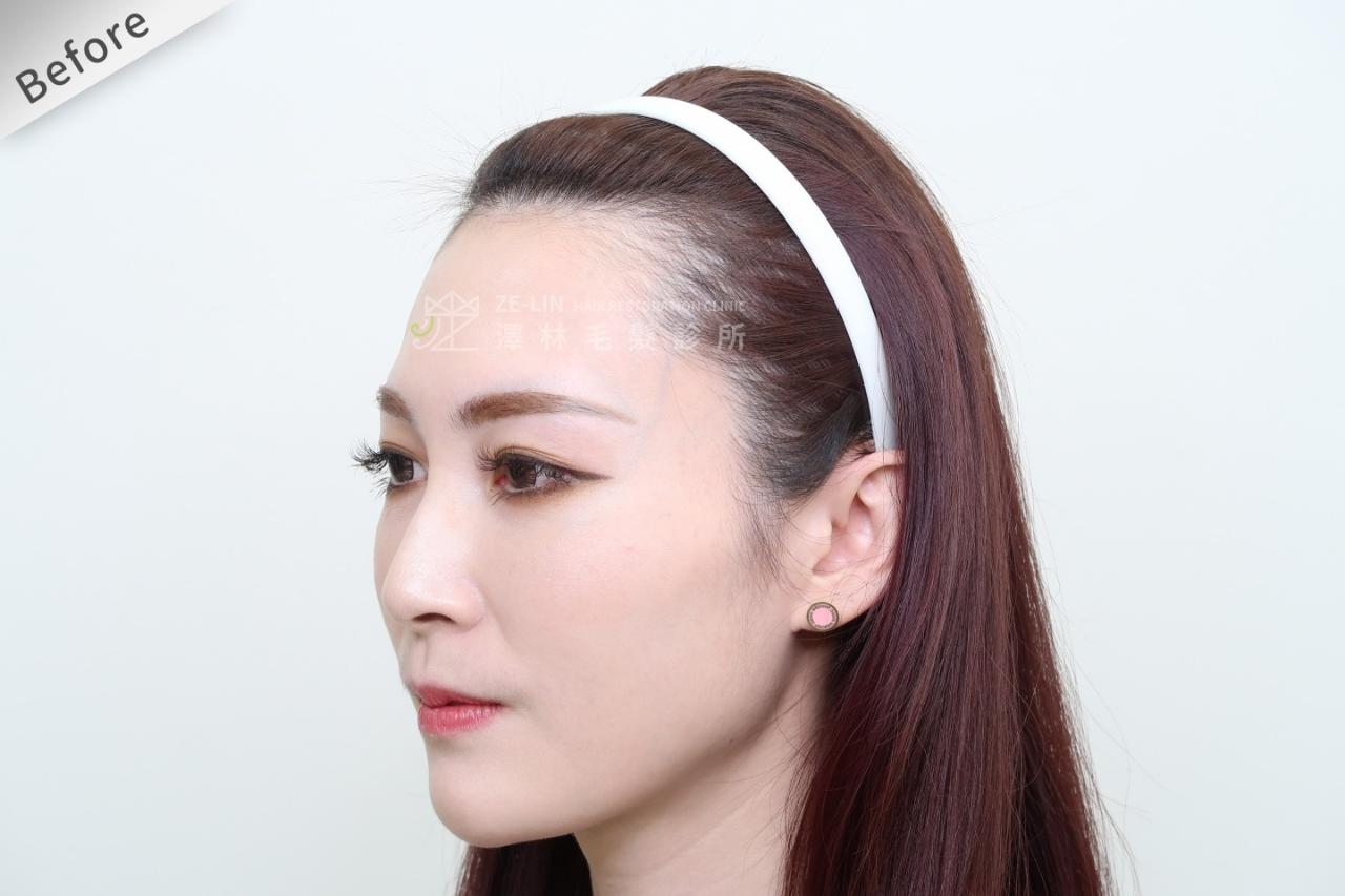 [女性植髮]女性高額頭植髮術前2-3