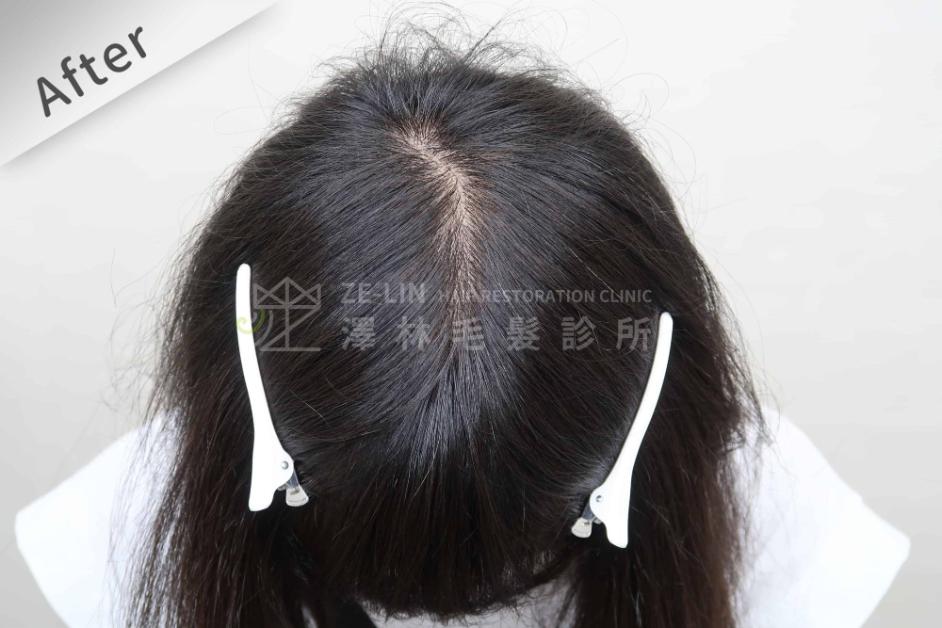 女性頭頂植髮案例3-術後