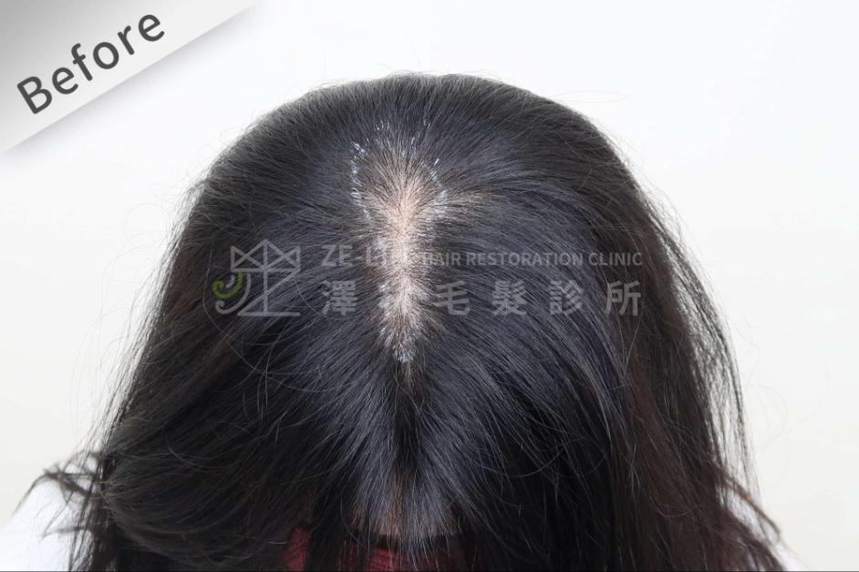 女性頭頂植髮案例4-術前