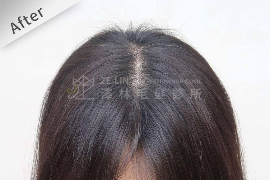 女性頭頂植髮案例4-術後