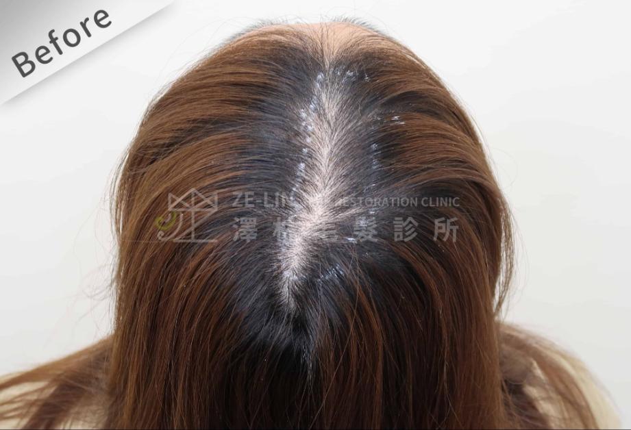 女性頭頂植髮案例5-術前