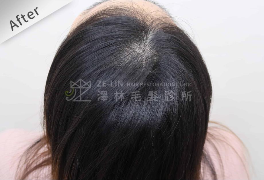 女性頭頂植髮案例5-術後