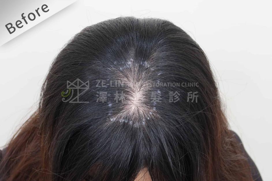 女性頭頂植髮案例6-術前