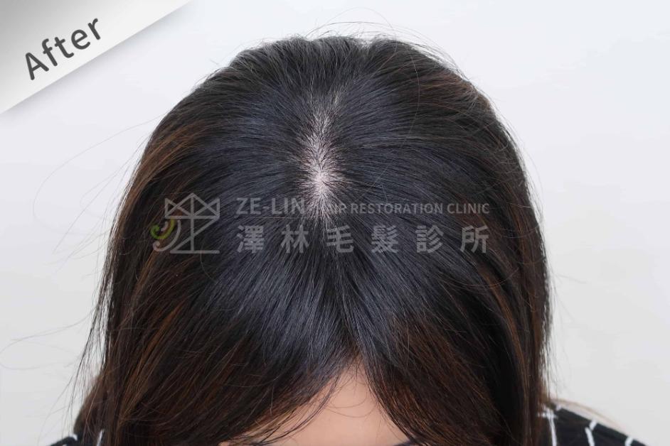 女性頭頂植髮案例6-術後