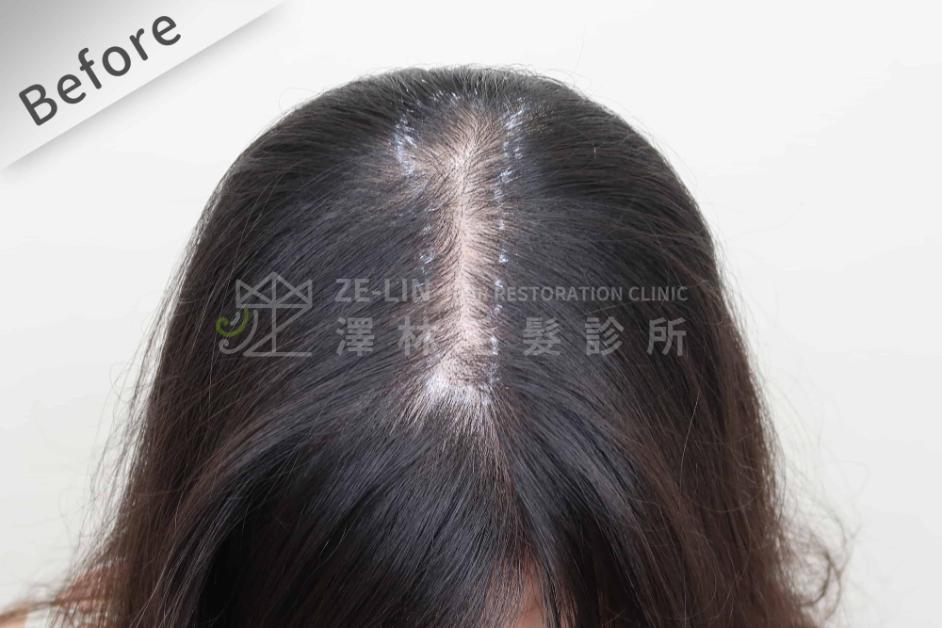女性頭頂植髮案例7-術前