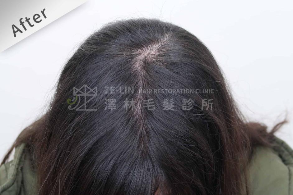 女性頭頂植髮案例7-術後