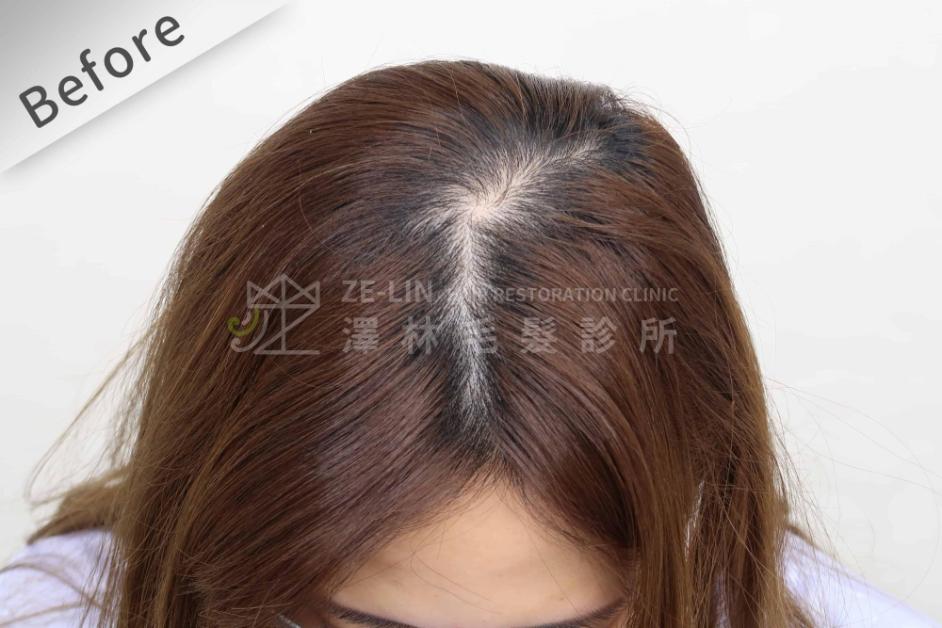 女性頭頂植髮案例8-術前