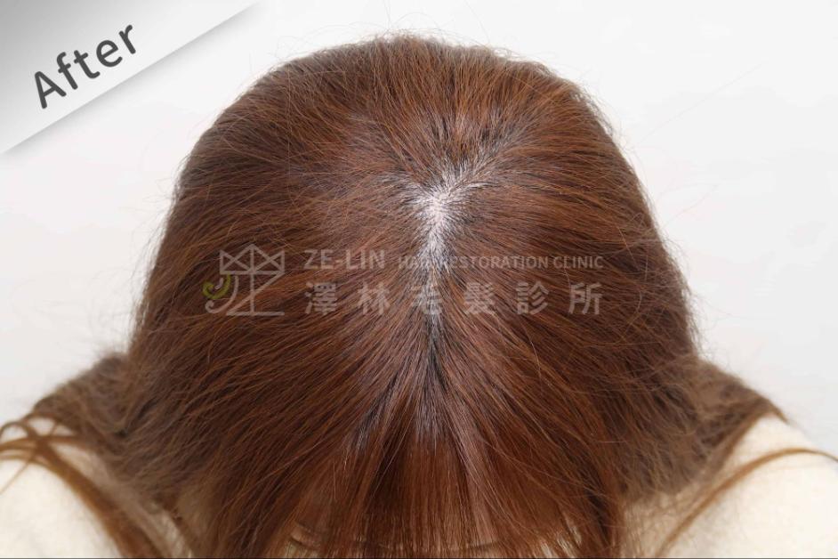 女性頭頂植髮案例8-術後