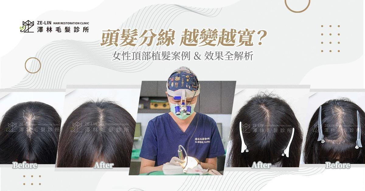女性頭頂植髮案例找回濃密髮量
