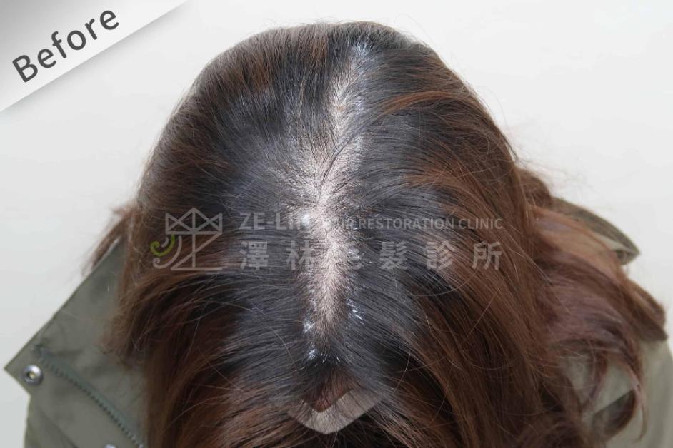 女性頭頂植髮案例1-術前